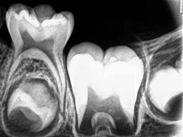 Child Dental Care