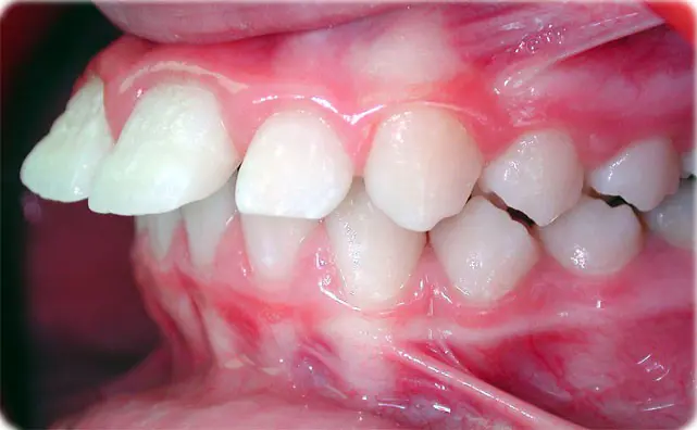 Orthodontic Braces Care