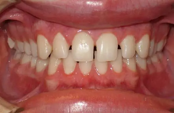 Smile Correction Treatment