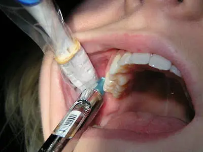 Wisdom Tooth Removal