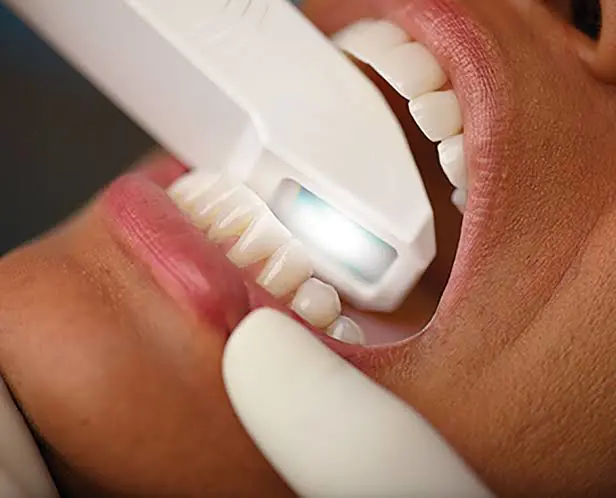 Dental Crowns & Bridges
