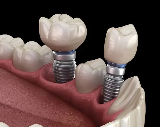 Dental Implant Solutions