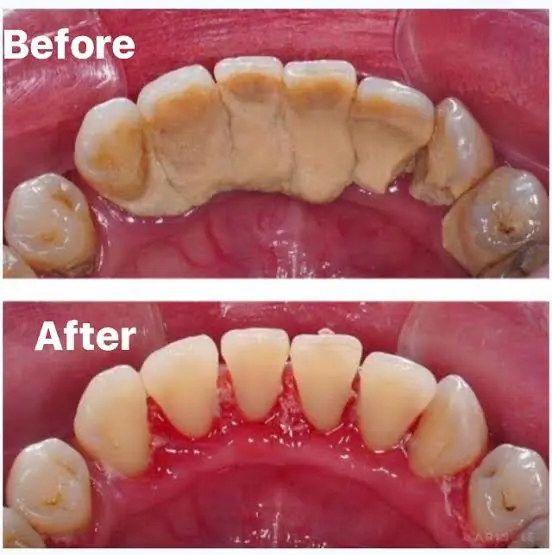 Teeth Cleaning Care