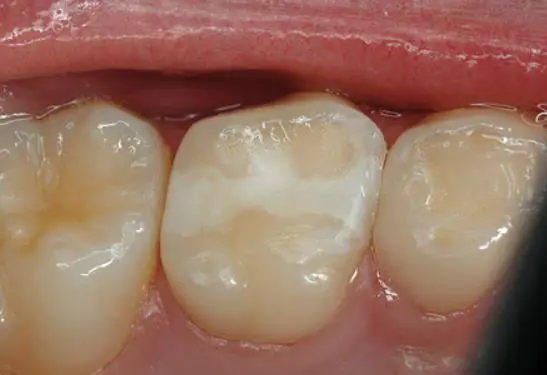 ooth Filling Treatment