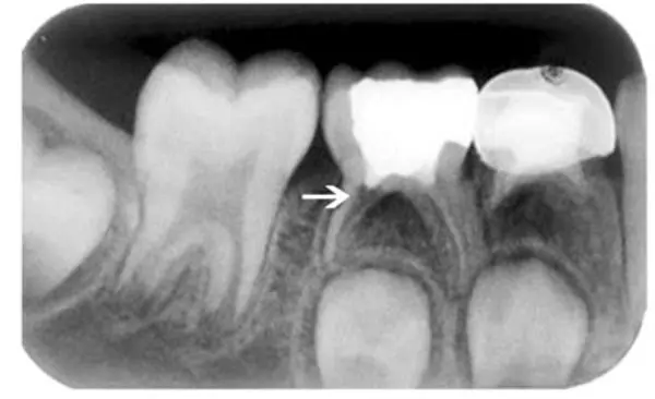 Child Dental Care
