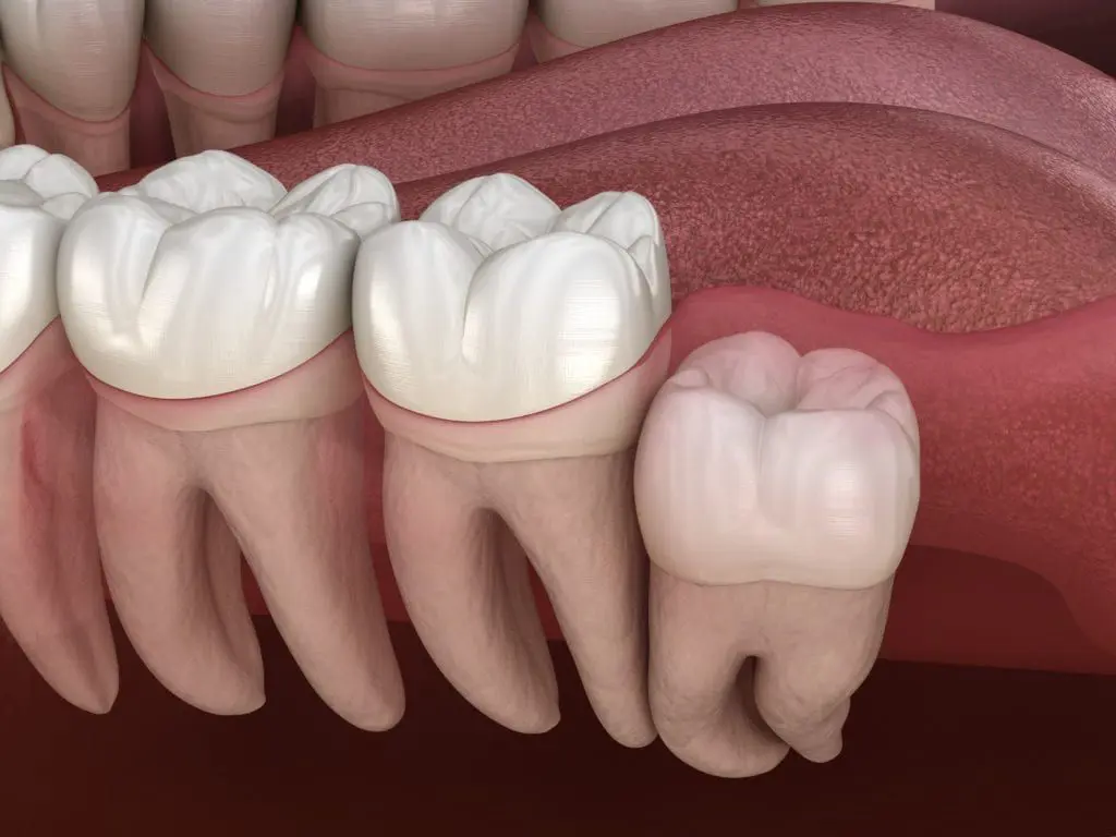 Wisdom Tooth Removal