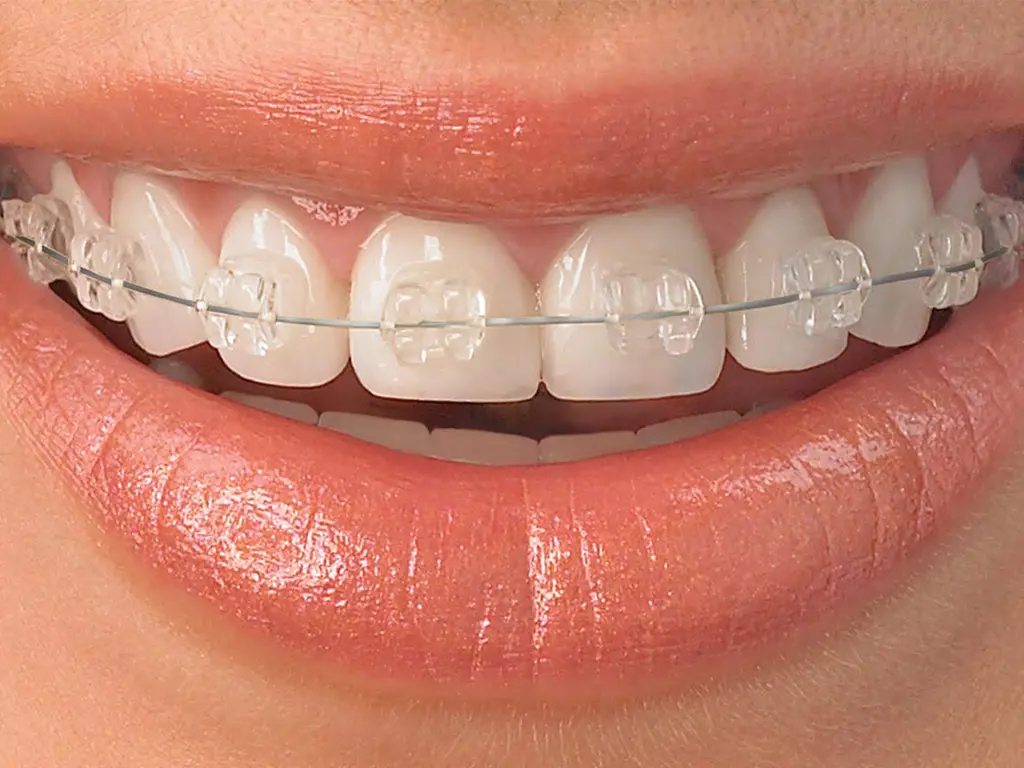 Orthodontic Braces Care