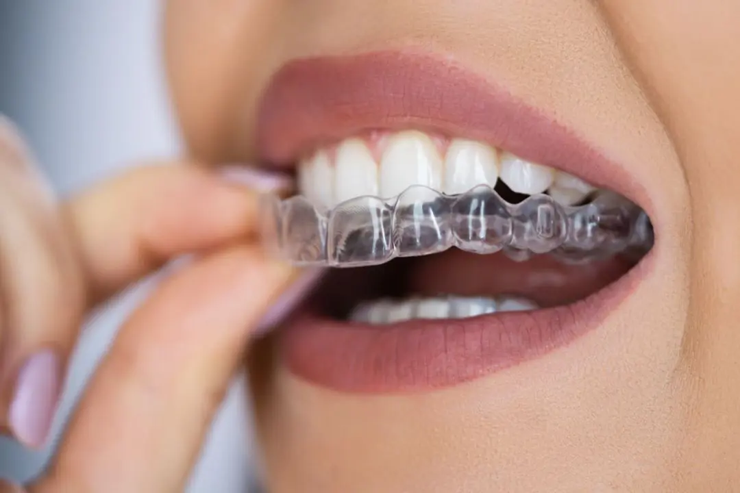 Clear Aligner Treatment