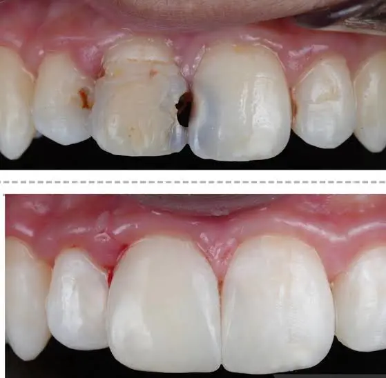 ooth Filling Treatment