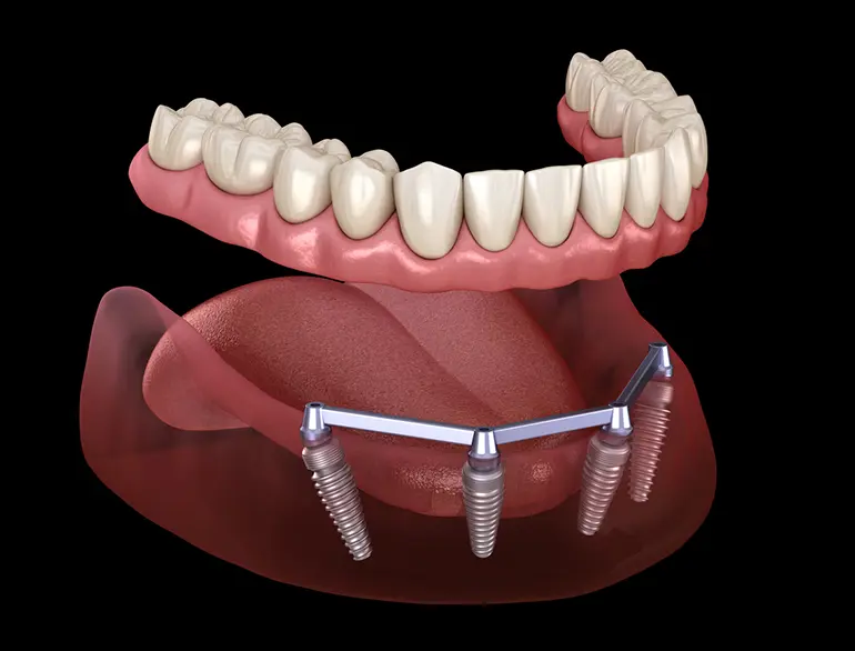 Dental Crowns & Bridges